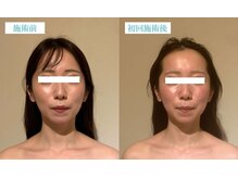 マリーボーテ 名古屋店/【小顔１回】一回りスッキリ