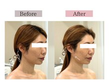 フロリール アザブジュウバン(FlorirAzabujuban)/小顔/リフト/たるみケア