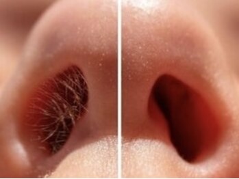 シンボディメイク 恵比寿(SiN BODY MAKE)/鼻毛ワックス Before→After