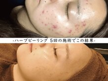 リンネ(Rin'ne)の雰囲気（リピート続出！大人気【ハーブピーリング】納得のこの結果☆）