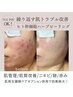 【繰り返す肌トラブル改善】ヒト幹細胞ハーブピーリング<ニキビ/跡/赤み>