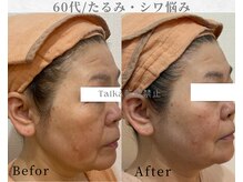 タイカ(Taika)の雰囲気(【たるみ・シワ・ほうれい線】引き上げ!アイロン級フェイシャル)
