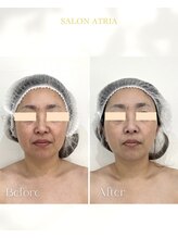 アトリア(ATRIA)/ゼオライト活性水素マスク