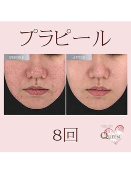 クイーン(QUEEN)の写真/一度で感動！？このツヤ、やみつき♪プラチナピールでうるツヤ水光肌へ