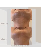 リモアボーテ(RIMOA beaute)/施術メニュー　お顔まるごと脱毛