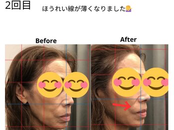 ベル/50代の方の小顔Before After