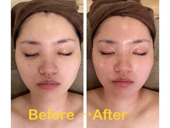 エステティックサロン ココチ(Cocochi)/美顔コルギ+ラジオ波