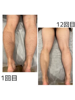 ミスト(MISTO)/【メンズ脱毛】