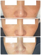 ニコサロン(nico salon)/ソフトピーリング