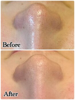 ルル 北仙台/お客様Before/After　毛穴