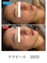 ユフラ(Juhla)/ララピール