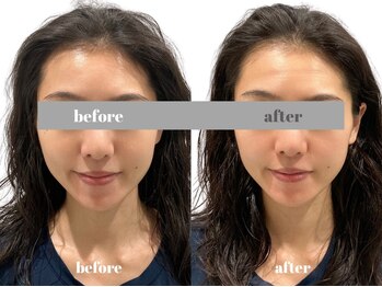 福多整体院/小顔美肌1回の効果