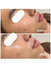 ミヌ 心斎橋(Minou)/ハーブピーリングbefore/after