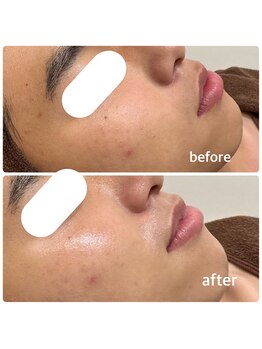 ミヌ 心斎橋(Minou)/ハーブピーリングbefore/after