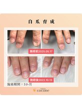 ココネ(cocone)/自爪育成