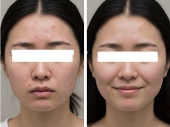 香嬉琉/ハーブピーリングニキビケア