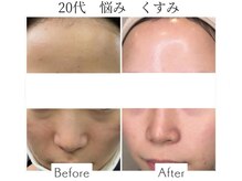 ファニービー 吹田店/20代 くすみ 12ヶ月で改善