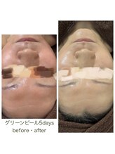 デイジー/グリーンピール5days