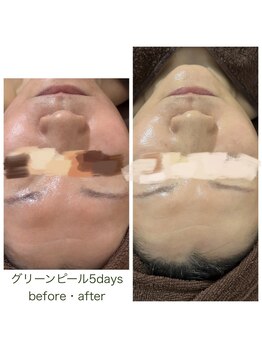 デイジー/グリーンピール5days