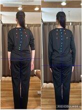 ナチュール(Nature)/側弯ビフォーアフター