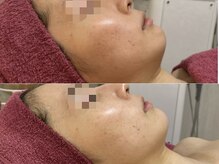 GRACETHOUSAND(グレイスサウザンド)/ハーブピーリング/洗浄/くすみ