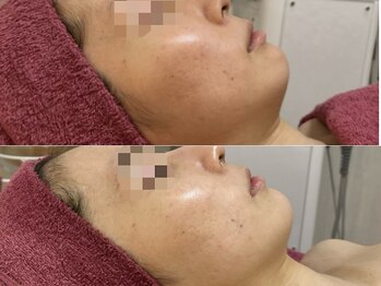 GRACETHOUSAND(グレイスサウザンド)/ハーブピーリング/洗浄/くすみ