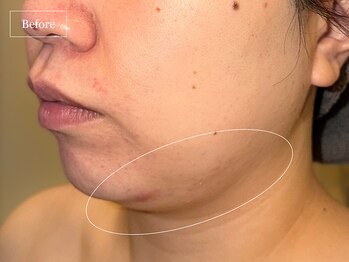 キュレイテッドスキン(CURATED SKIN)/レモンボトル/脂肪分解美容液