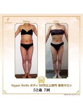 リンカ(Rinka.)/☆帯広初!!ハイパーナイフ導入☆