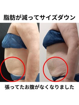 ホワイトビューティーラボ(White Beauty Lab)/【痩身】腹部×２回施術後