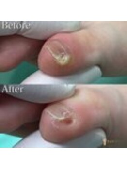 巻き爪補正店 水戸駅前店/【副爪ケア】