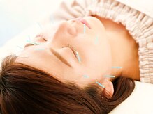 すぎの木鍼灸院の雰囲気（美容鍼でリフトアップ＆美容液導入で肌質改善していきます）