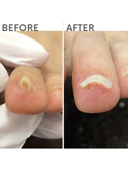 クオッカ(Quokka)/第二趾の巻き爪ケア