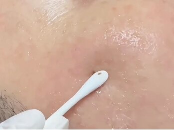 エスビーエス オキナワ(SBS OKINAWA)の写真/シミケア特化！【韓国発”Nuare”ニュアレ導入♪】SNSで話題★沖縄の強い紫外線もダメージケア◎￥2,750～