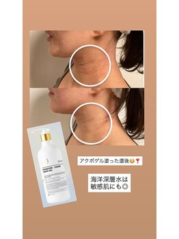 ひっそり美肌構築/アクボゲルは敏感肌にも◎