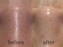 ウィズルーチェ 神栖店(with luce)/毛穴洗浄１回効果★鼻黒ずみ毛穴