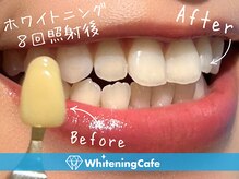 ホワイトニングカフェ 千葉店/ホワイトニング8回照射後＊女性