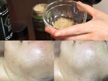 ブレア(Blair)/【O.H.Lハーブピーリング】