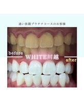 ホワイト 川越店(WHITE)/歯のbefore→after