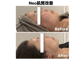 ネオファースト(NeoFirst)/肌質改善【20代女性】