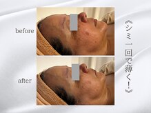 ジュプン 長崎/クリスタルパック1回の変化！