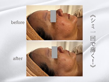 ジュプン 長崎/クリスタルパック1回の変化！