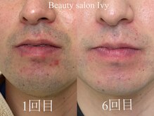 ビューティー サロン アイビー(Ivy)/ヒゲ脱毛