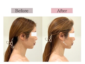 フロリール アザブジュウバン(FlorirAzabujuban)/小顔/リフト/たるみケア