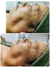 ナチュラルビューティラテ(NATURAL BEAUTY LATTE)/レチノールモニター