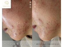 チル 名古屋栄(CHILL)/ハーブピーリング