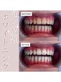 エクシアホワイトニング 倉敷店 通い放題プランで理想の白さをキープ♪男性にも人気セルフケア!