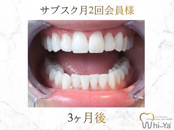ホワイヤ セルフホワイトニング DBS神楽坂(Whi-Ya)/☆サブスク会員様☆納得の白さ☆