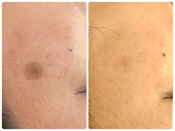 ルーミー(LUME.)/老半のしみも最短で改善