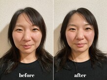 福多整体院/小顔美肌2回の効果