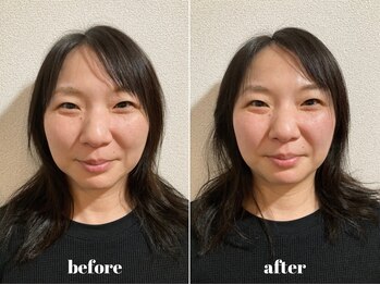 福多整体院/小顔美肌2回の効果